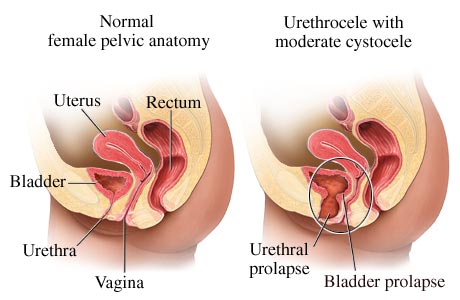 Urethrocele