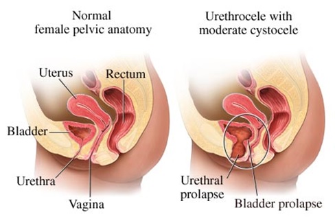 Urethrocele