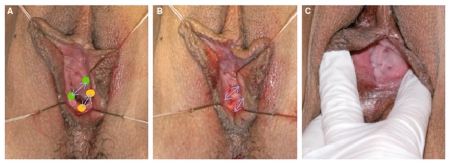 alinsod denuding hymenoplasty