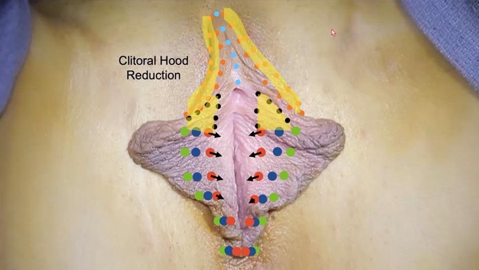 Clitoral Hood Reduction