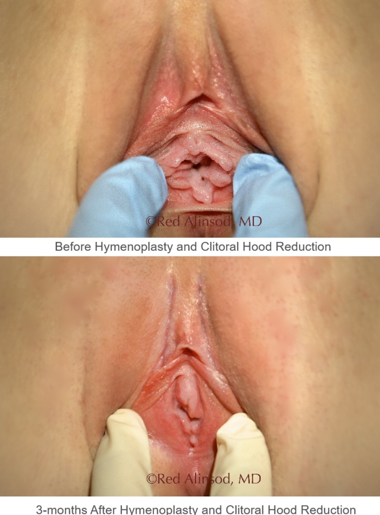 hymenoplasty