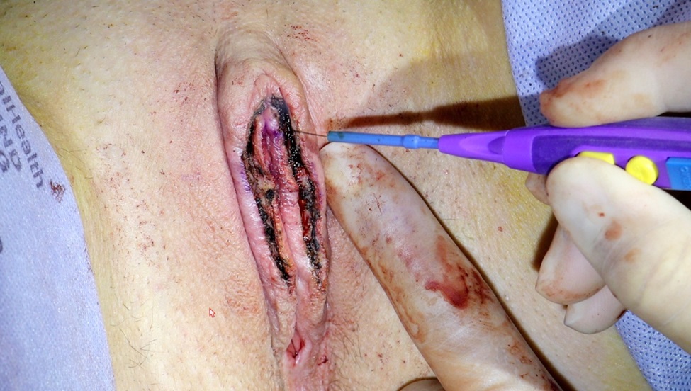 labia minora -surgery