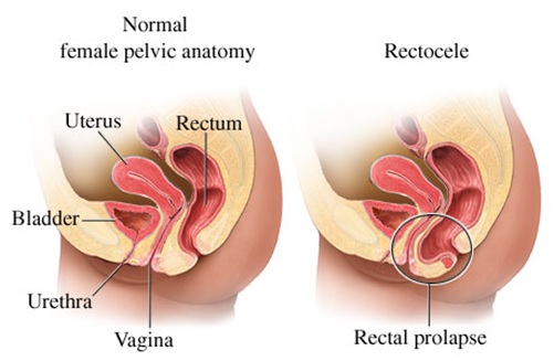 rectocele