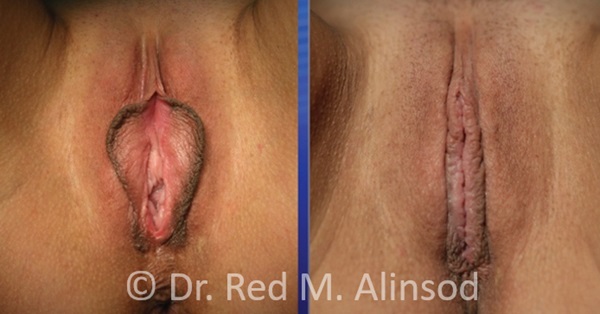 rim-look labiaplasty minora