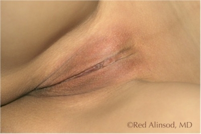 Labiaplasty Barbie Look